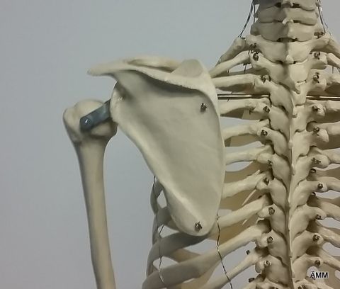 Impingmentsyndrome Impingmentsyndrome